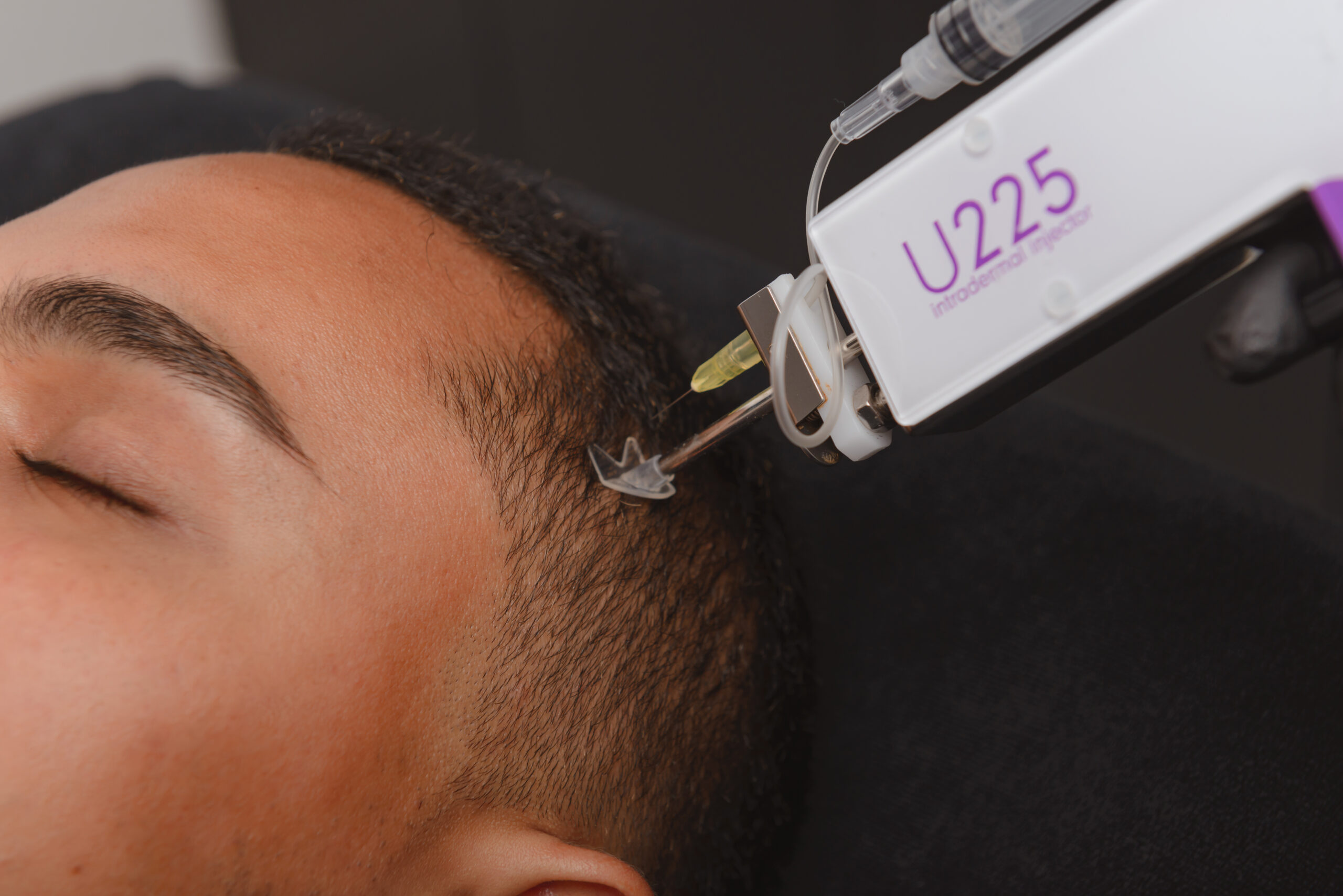 Mesotherapy_amsterdam