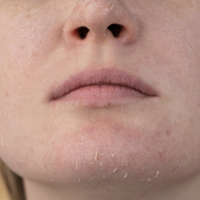 Dry skin