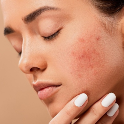 Sensitive skin