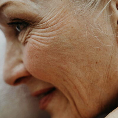 Aging skin