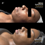 Hydrafacial