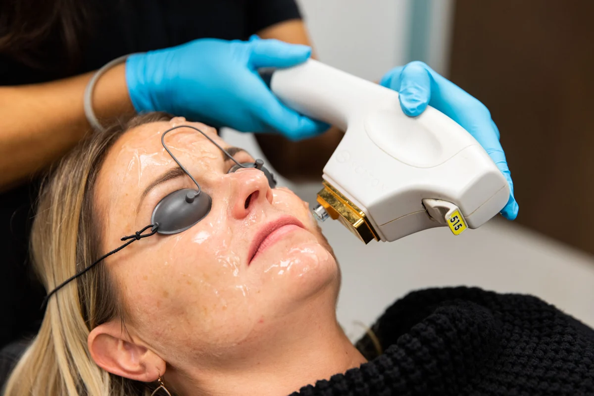 Sciton BBL treatment photograph from the existing ACC website