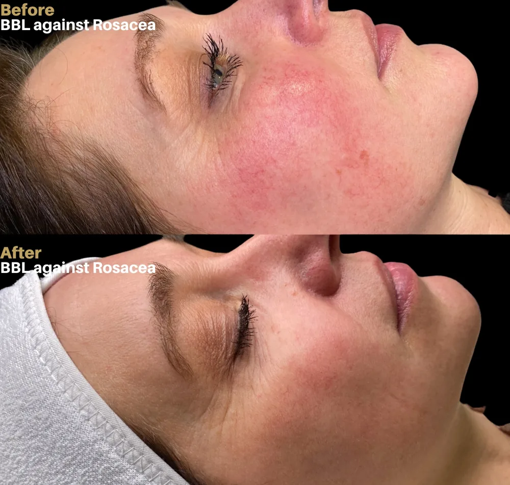 Before-and-after BBL result for redness associated with rosacea at Amsterdam Cosmetic Clinic