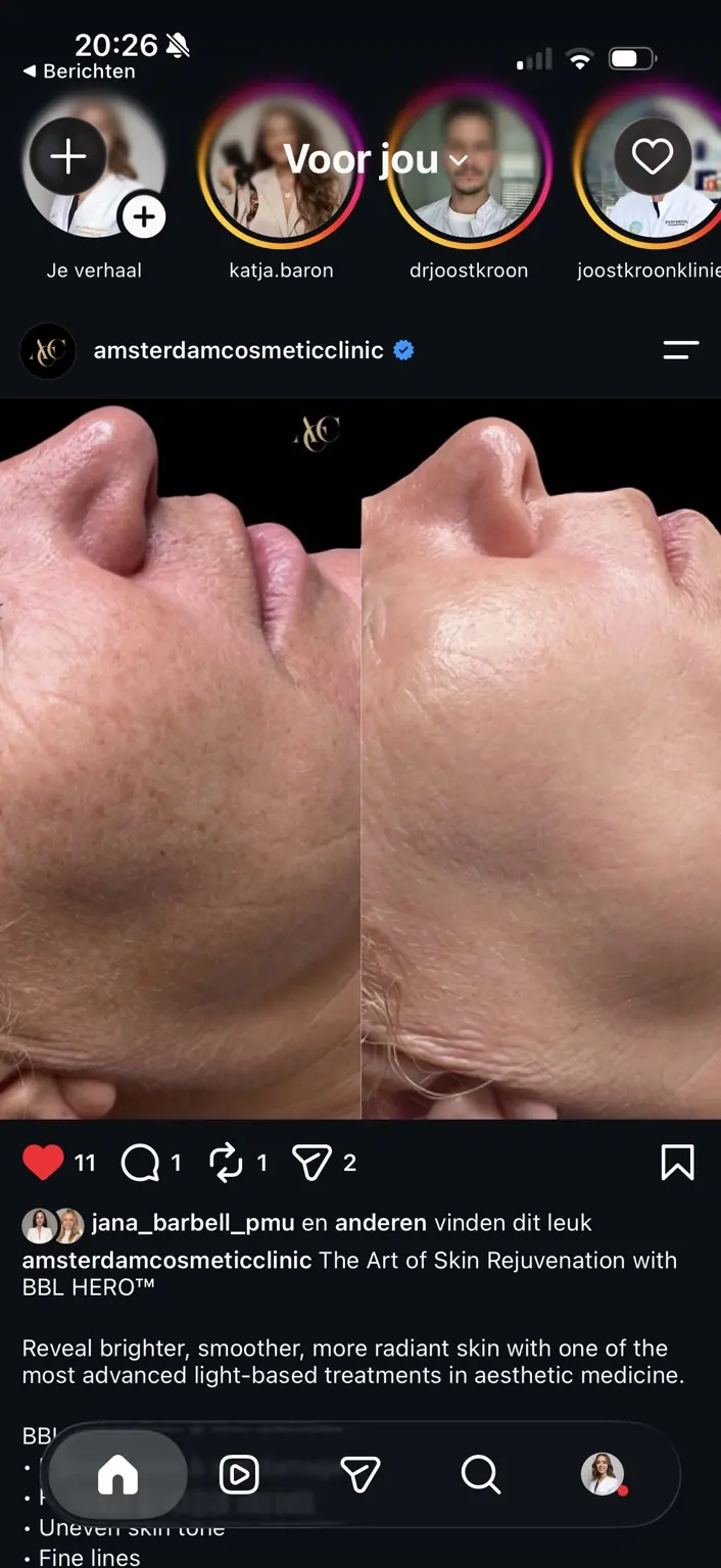 BBL HERO result from Amsterdam Cosmetic Clinic, before on the left and after on the right