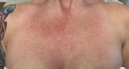 Sun-damaged décolletage before BBL HERO, external Sciton case