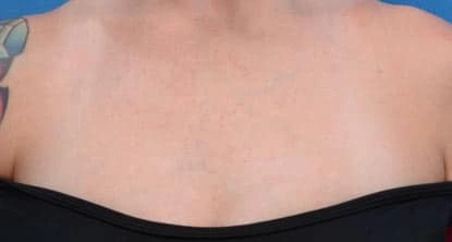Décolletage after BBL HERO, external Sciton case