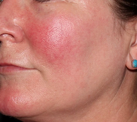 Redness on the cheek before BBL HERO, external Sciton case