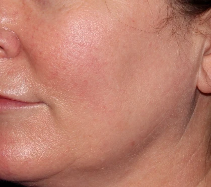 Cheek after three BBL HERO treatments, external Sciton case