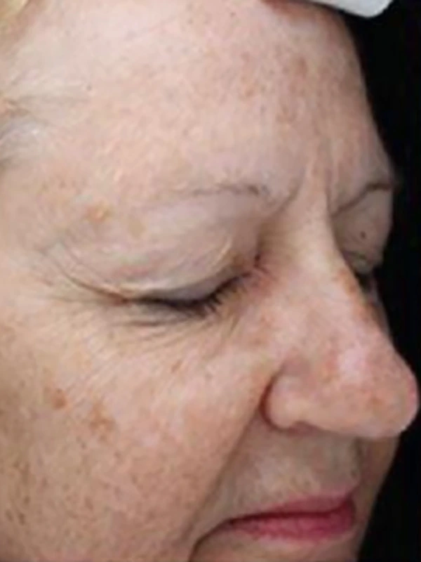 Face before treatment in an external case by Laura Granger