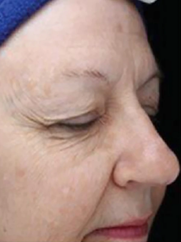 Face after treatment in an external case by Laura Granger