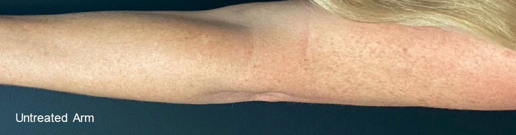 Arm with pigmentation before BBL HERO, external Sciton case