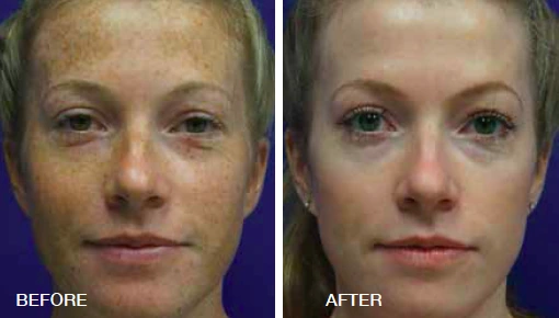 Face with pigmentation before and five months after one BBL treatment, external Sciton case