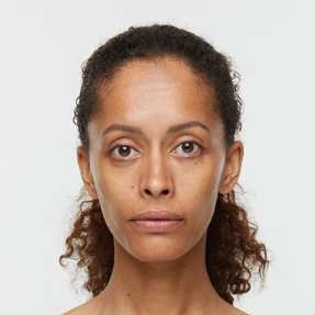 Example of volume loss before Sculptra