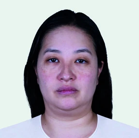 Example of a slimming lift before Sculptra