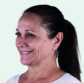 Skin quality example before Sculptra