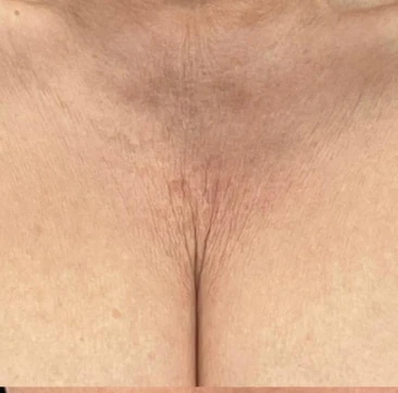 Maria's décolletage before Sculptra