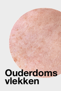 Ouderdoms vlekken / Age spots