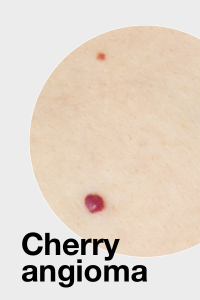 Kersenwratje / Cherry angioma