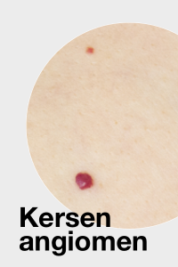 Kersen wratje / Cherry Angioma