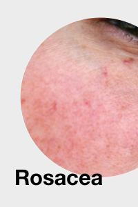 Rosacea /