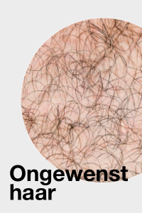 Ongewenst haar / Unwanted hair