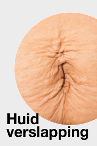 Huid verslapping / Skin laxity