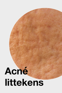 Acne littekens / Acne scars