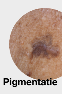 Pigmentatie / Pigment spot