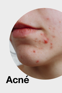 Acne huid / Acne skin