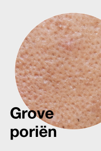 Grove poriën / Visible pores