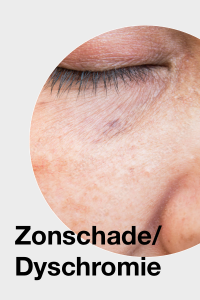 Zonneschade Dyschromie / Sun damage Dyschromia